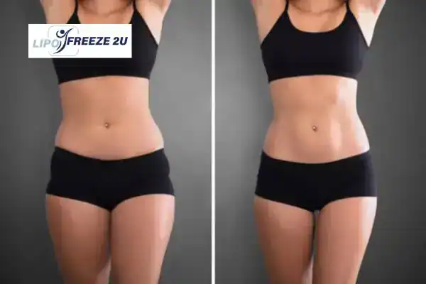 How Can LIPO FREEZE 2U Support Your Post-Pregnancy Body Recovery Chesham?