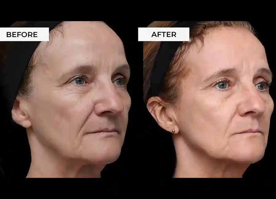 How Many RF Microneedling Sessions Will You Need to See a Difference Chesham?