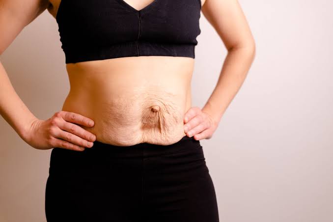 Is Surgery Really the Only Way to Repair Diastasis Recti Chesham?