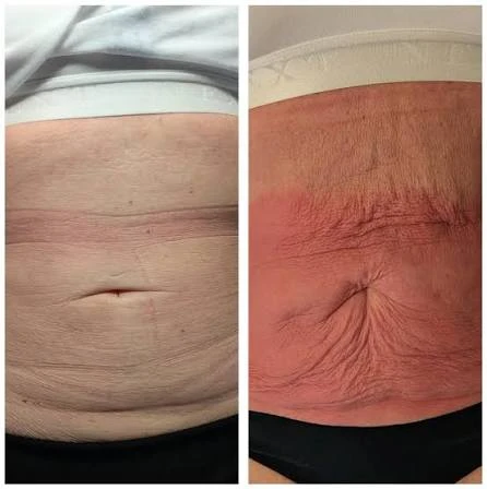 How Does RF Microneedling Improve Crepey, Thin and Uneven Skin Texture Chesham?