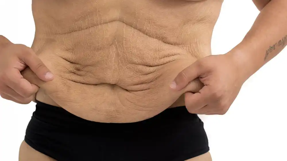 RF Microneedling for Loose Skin: How Can It Help Tighten and Reshape the Skin Chesham?